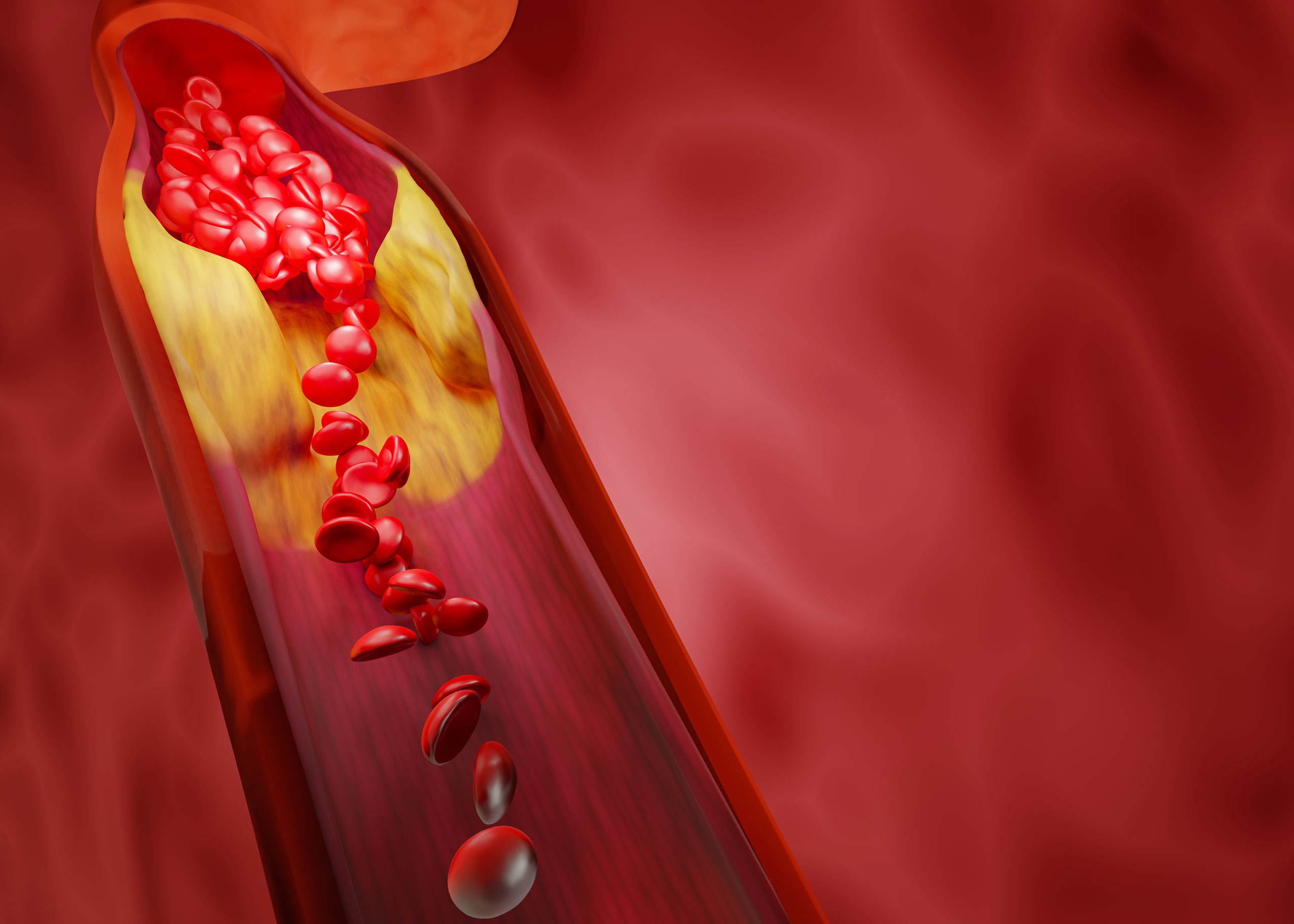 25 Fakty O Hiperlipidemia
